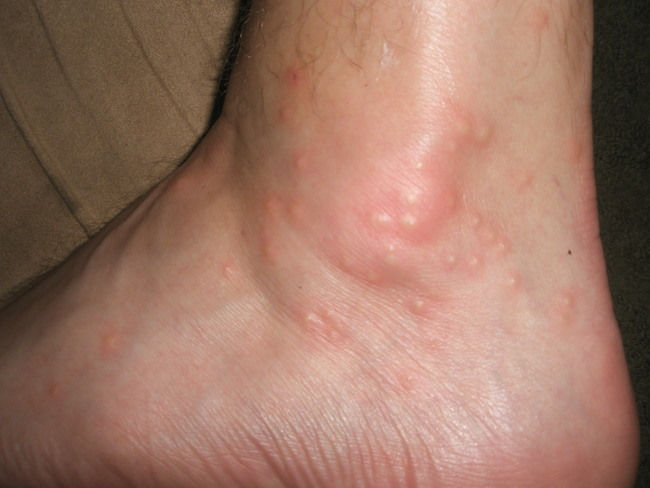are these little bites all over my ankles flea bites ...